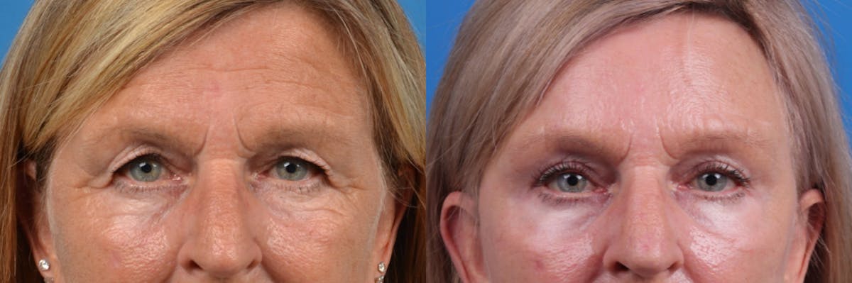 Brow Lift Before & After Gallery - Patient 122405624 - Image 2