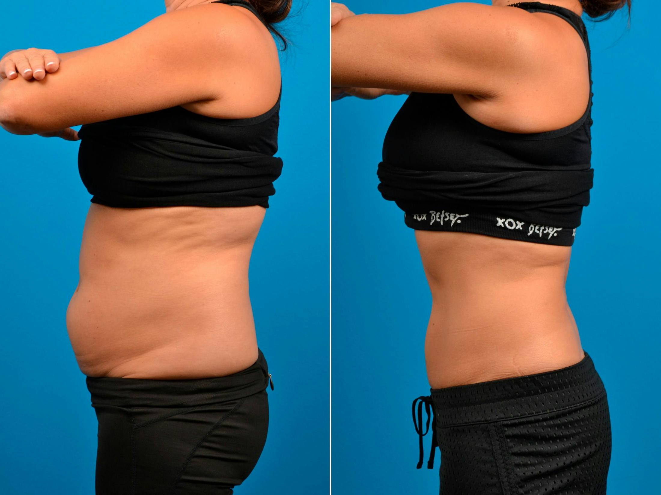 CoolSculpting Before & After Gallery - Patient 122405623 - Image 5