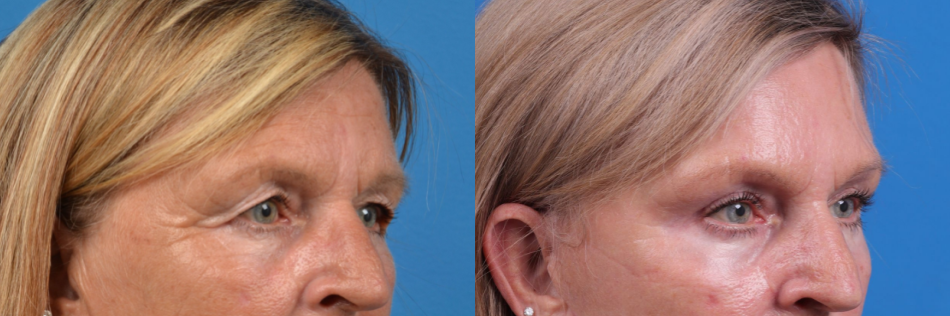 Brow Lift Before & After Gallery - Patient 122405624 - Image 3