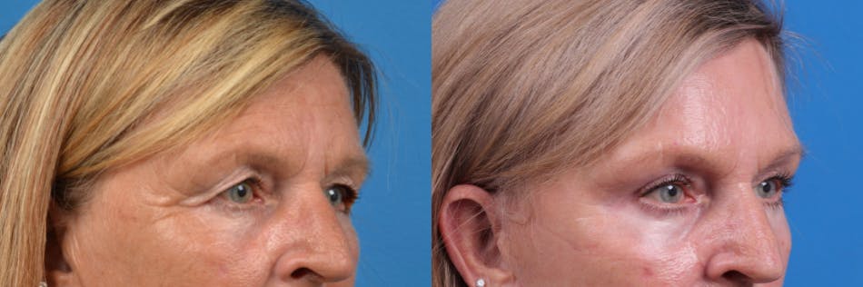 Brow Lift Before & After Gallery - Patient 122405624 - Image 3