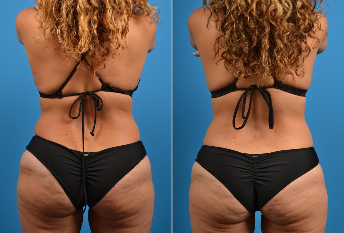 CoolSculpting Before & After Gallery - Patient 122405625 - Image 1