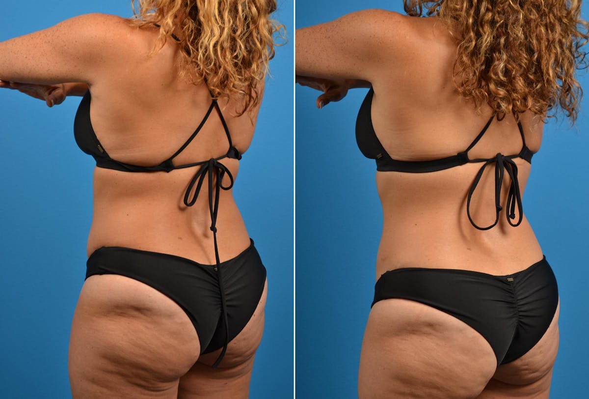 CoolSculpting Before & After Gallery - Patient 122405625 - Image 2