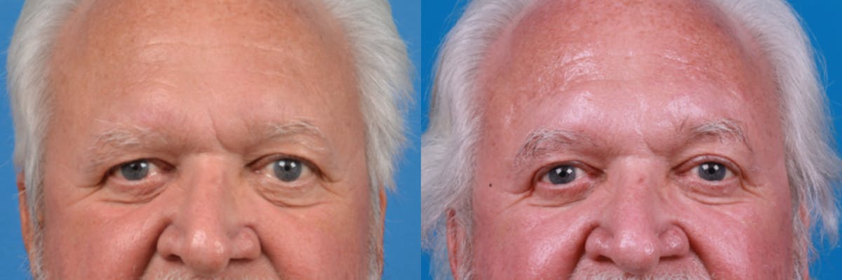 Brow Lift Before & After Gallery - Patient 122405626 - Image 2