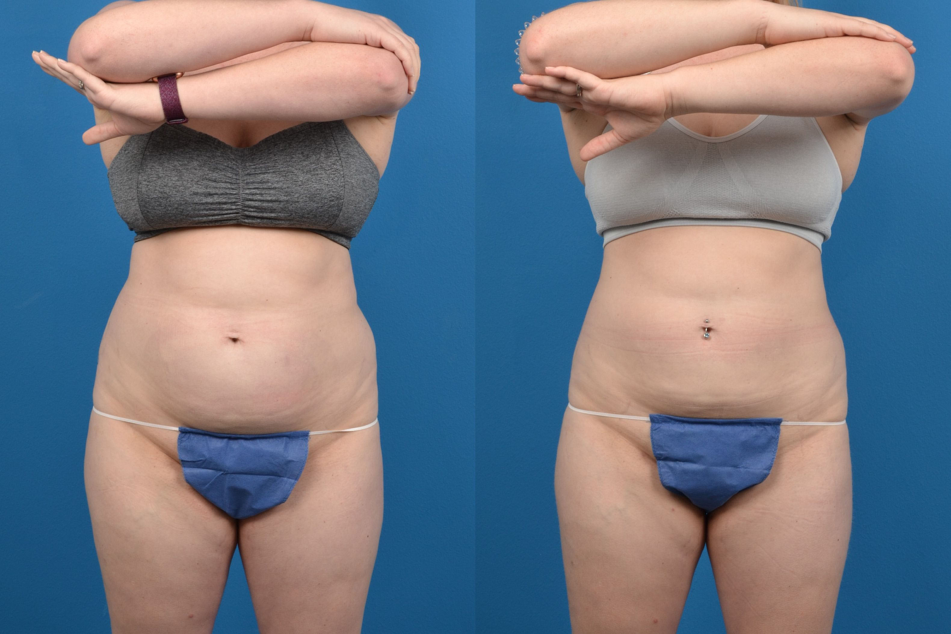 CoolSculpting Before & After Gallery - Patient 347116 - Image 1