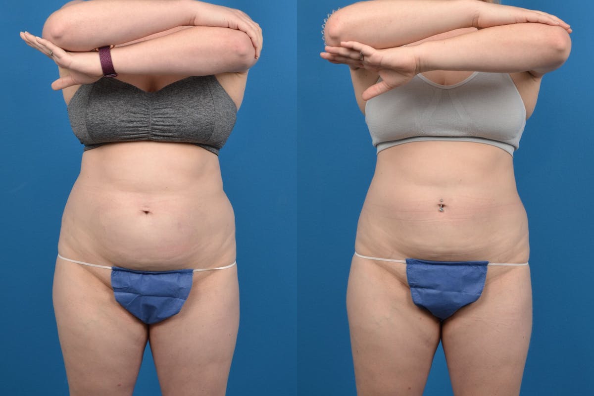 CoolSculpting Before & After Gallery - Patient 122405627 - Image 1