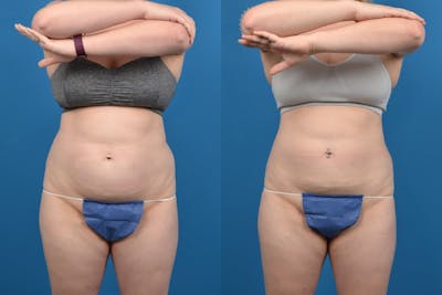 CoolSculpting Before & After Gallery - Patient 122405627 - Image 1