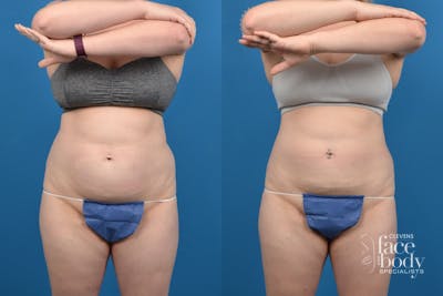 CoolSculpting Before & After Gallery - Patient 347116 - Image 1