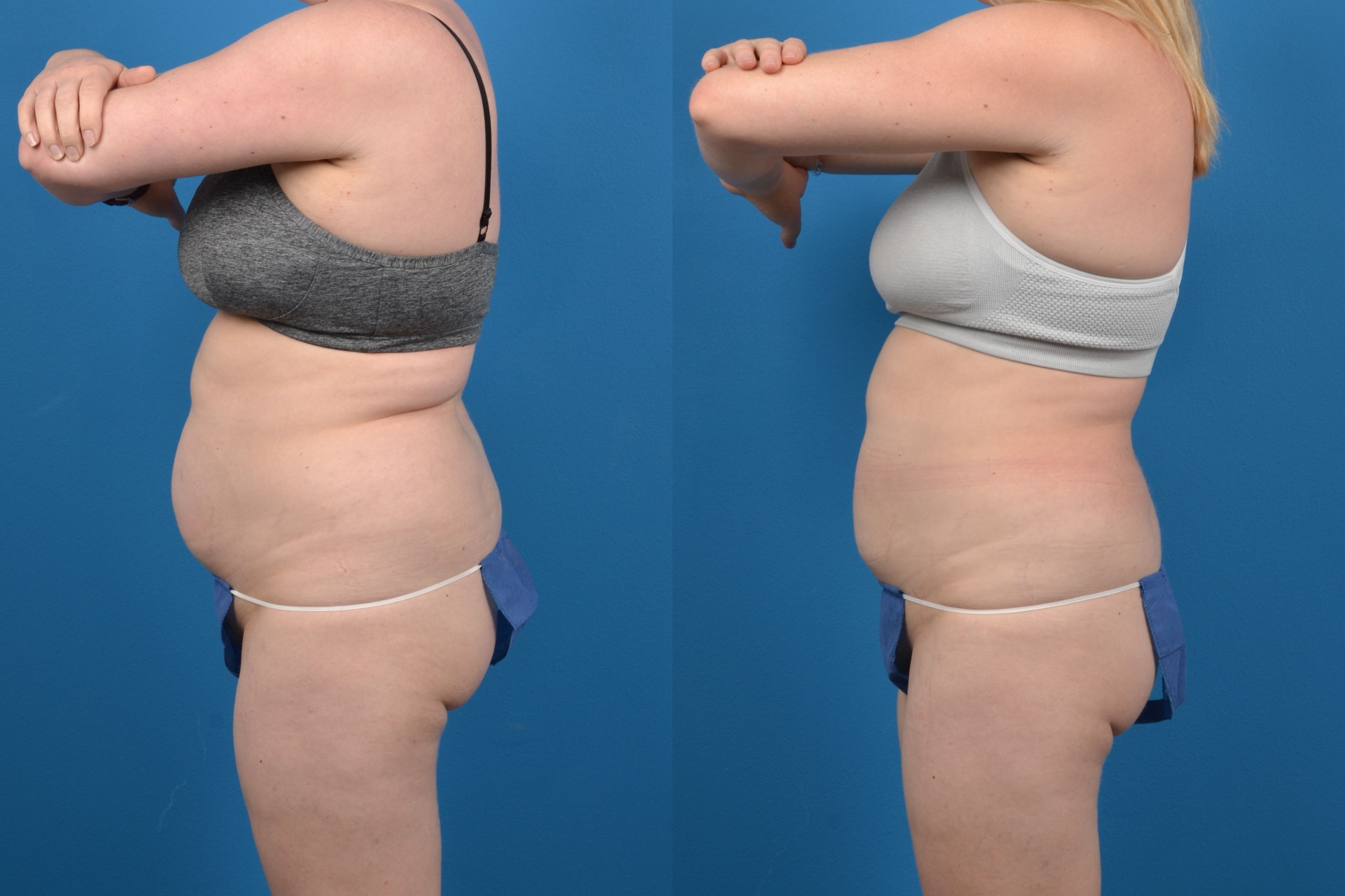 CoolSculpting Before & After Gallery - Patient 347116 - Image 2