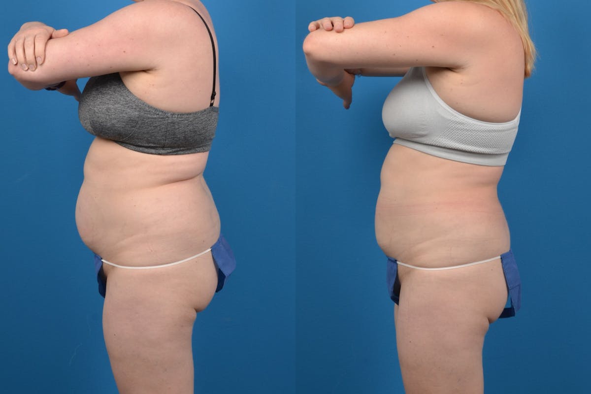 CoolSculpting Before & After Gallery - Patient 122405627 - Image 2