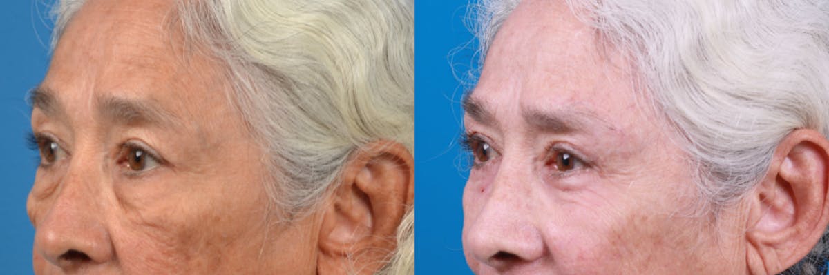 Brow Lift Before & After Gallery - Patient 122405629 - Image 1