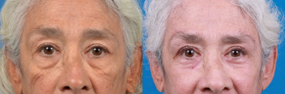 Brow Lift Before & After Gallery - Patient 122405629 - Image 2