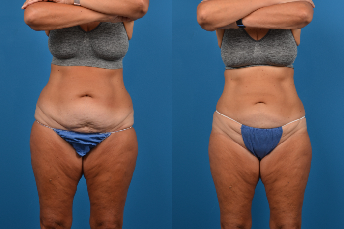 CoolSculpting Before & After Gallery - Patient 280461 - Image 1