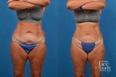 CoolSculpting Before & After Gallery - Patient 280461 - Image 1