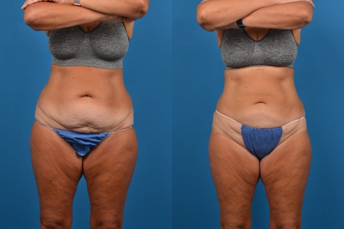 CoolSculpting Before & After Gallery - Patient 122405630 - Image 1
