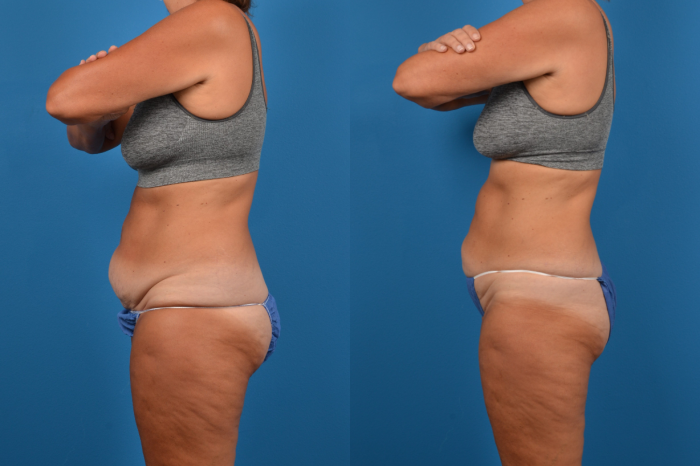 CoolSculpting Before & After Gallery - Patient 280461 - Image 2