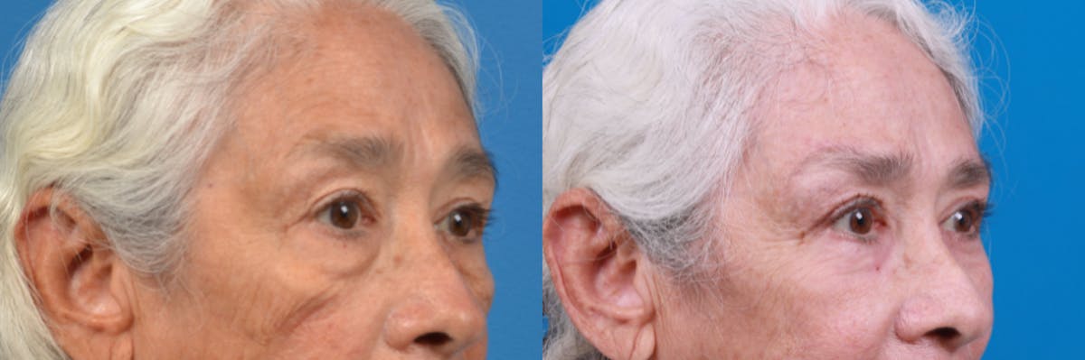 Brow Lift Before & After Gallery - Patient 122405629 - Image 3