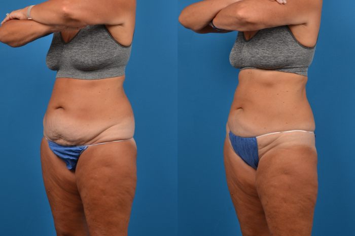 CoolSculpting Before & After Gallery - Patient 280461 - Image 3