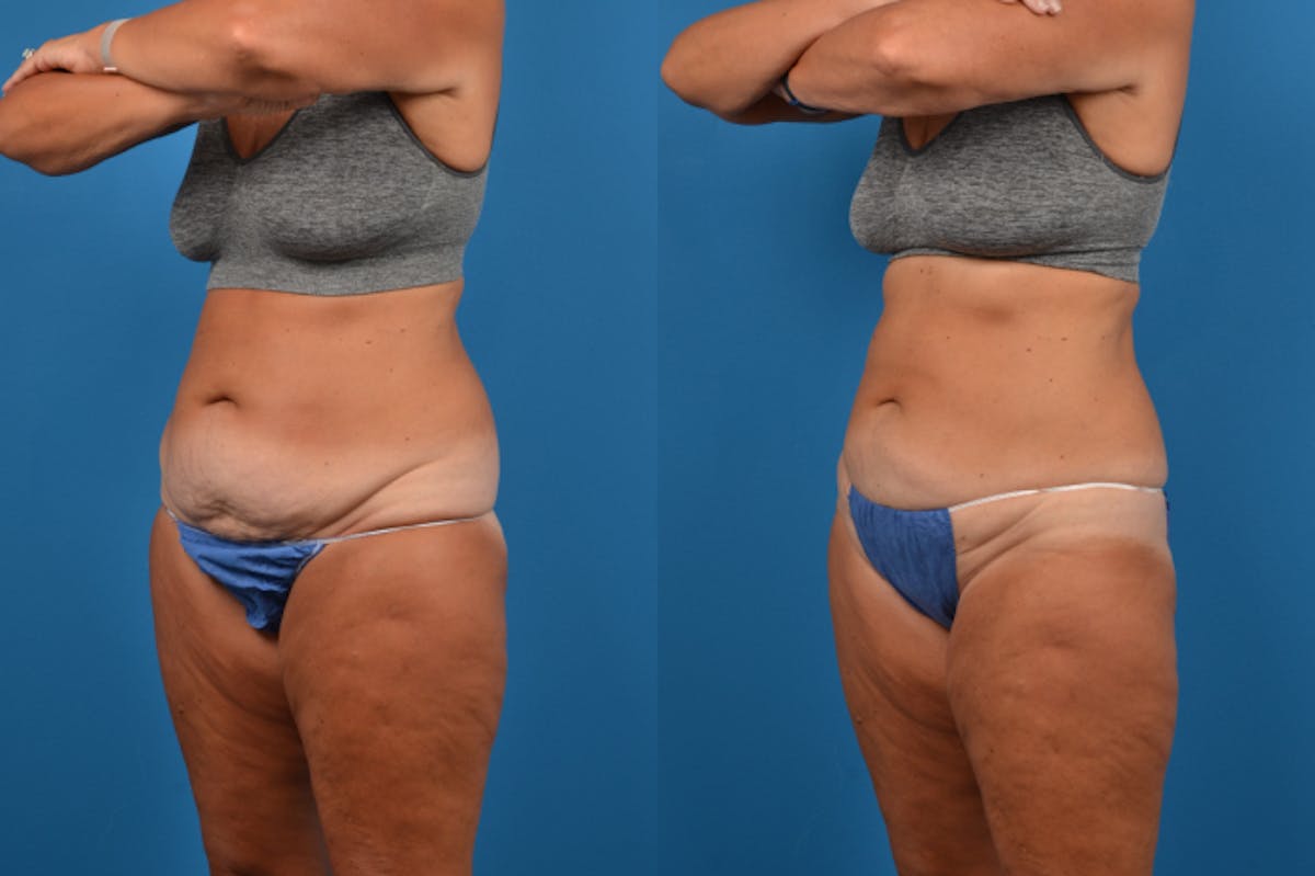 CoolSculpting Before & After Gallery - Patient 122405630 - Image 3