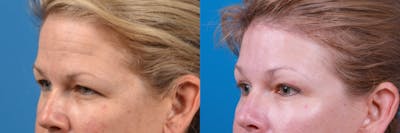 Brow Lift Before & After Gallery - Patient 122405631 - Image 1