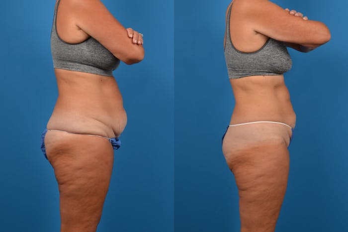CoolSculpting Before & After Gallery - Patient 122405630 - Image 4