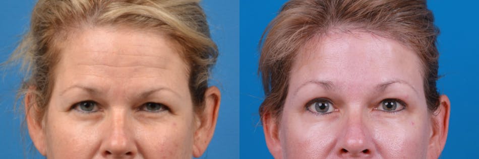 Brow Lift Before & After Gallery - Patient 122405631 - Image 2