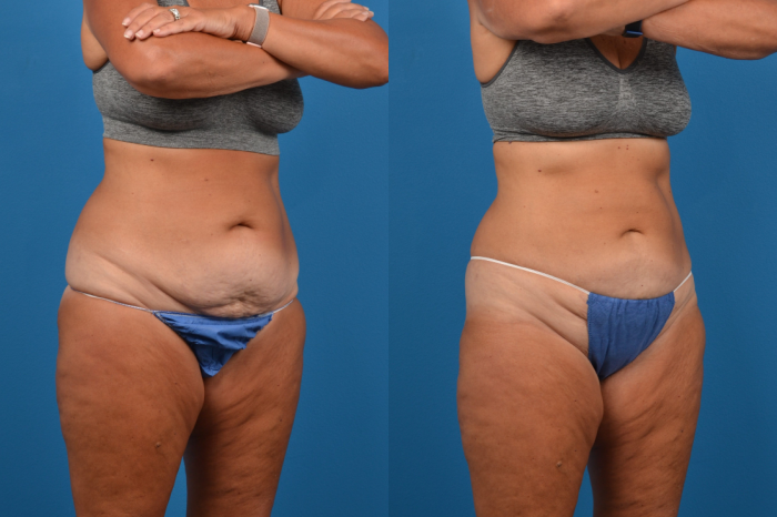 CoolSculpting Before & After Gallery - Patient 280461 - Image 5