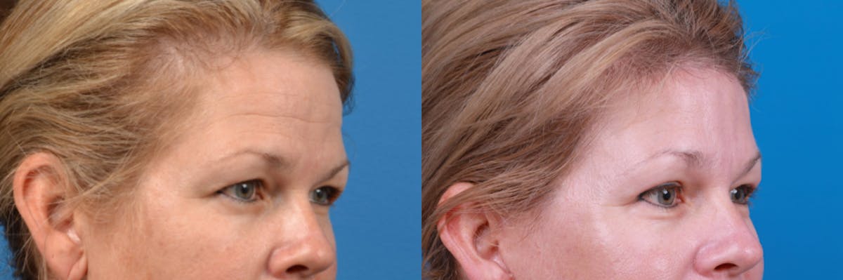 Brow Lift Before & After Gallery - Patient 122405631 - Image 3