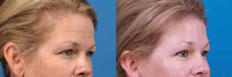 Brow Lift Before & After Gallery - Patient 122405631 - Image 3