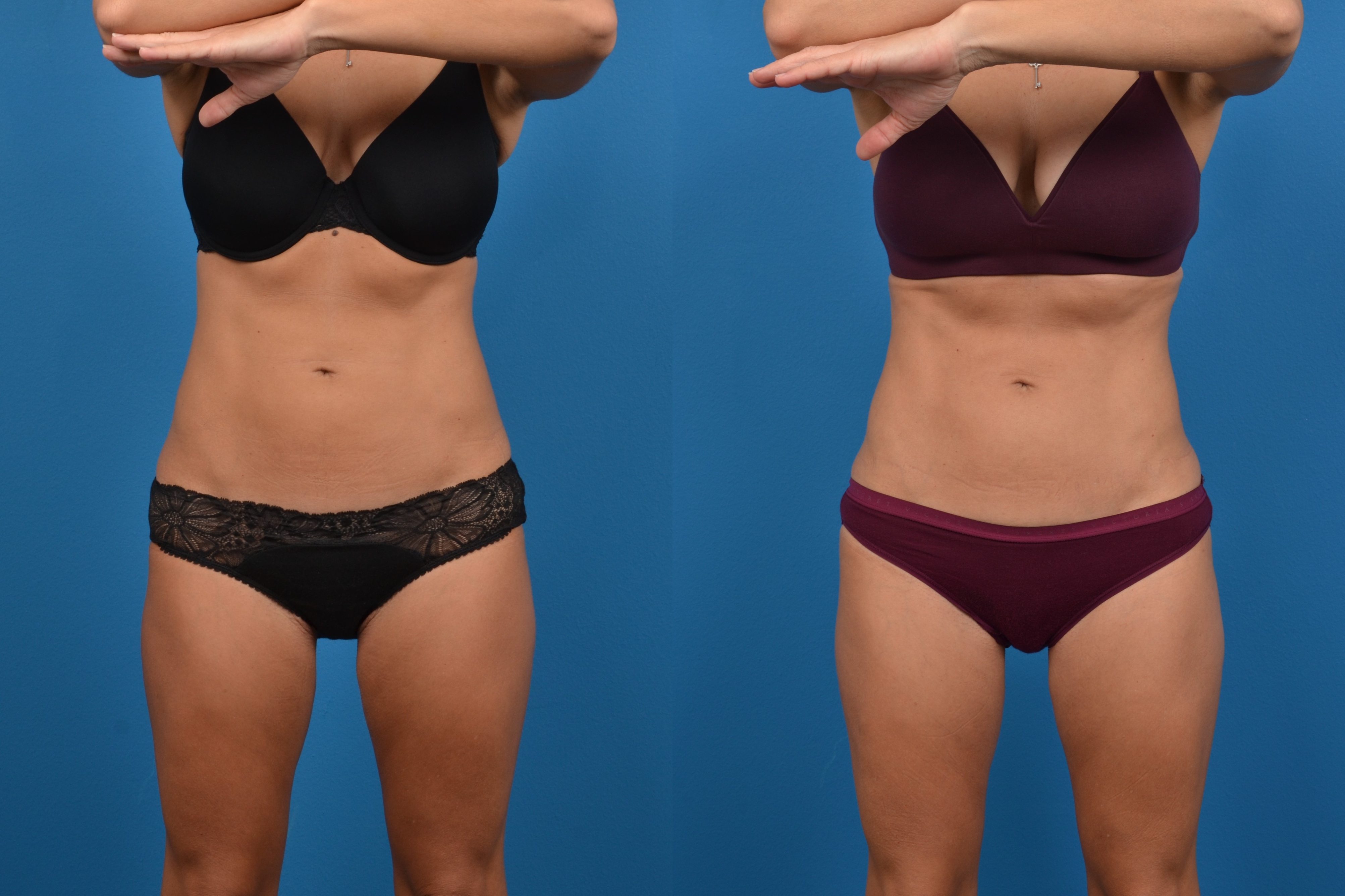 CoolSculpting Before & After Gallery - Patient 268673 - Image 1