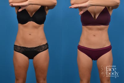 CoolSculpting Before & After Gallery - Patient 268673 - Image 1