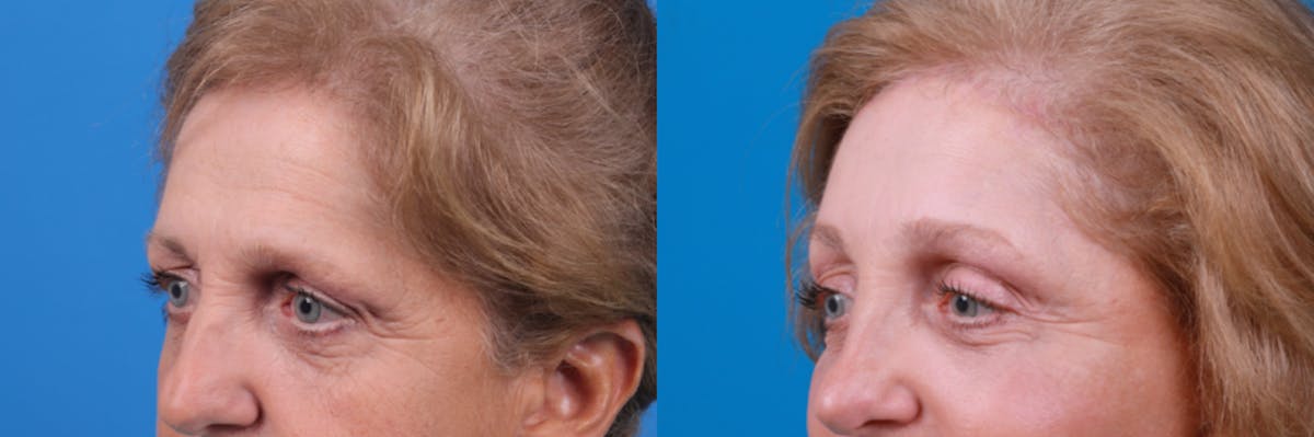 Brow Lift Before & After Gallery - Patient 122405633 - Image 1
