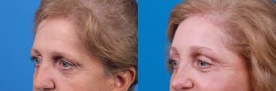 Brow Lift Before & After Gallery - Patient 122405633 - Image 1