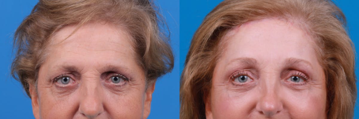 Brow Lift Before & After Gallery - Patient 122405633 - Image 2