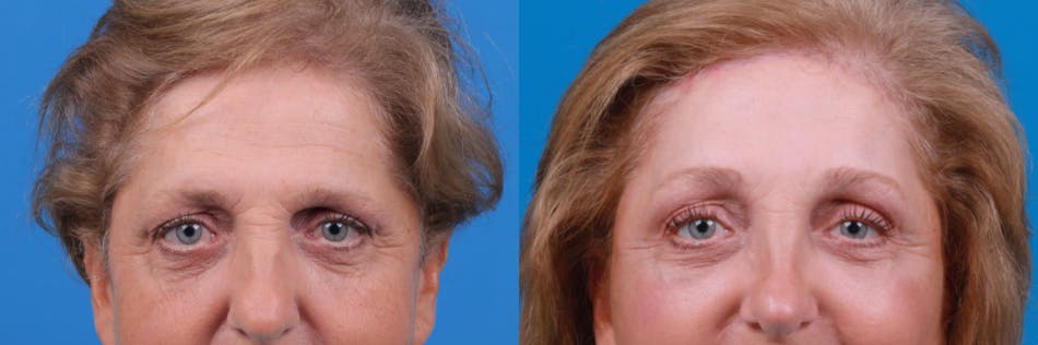 Brow Lift Before & After Gallery - Patient 122405633 - Image 2