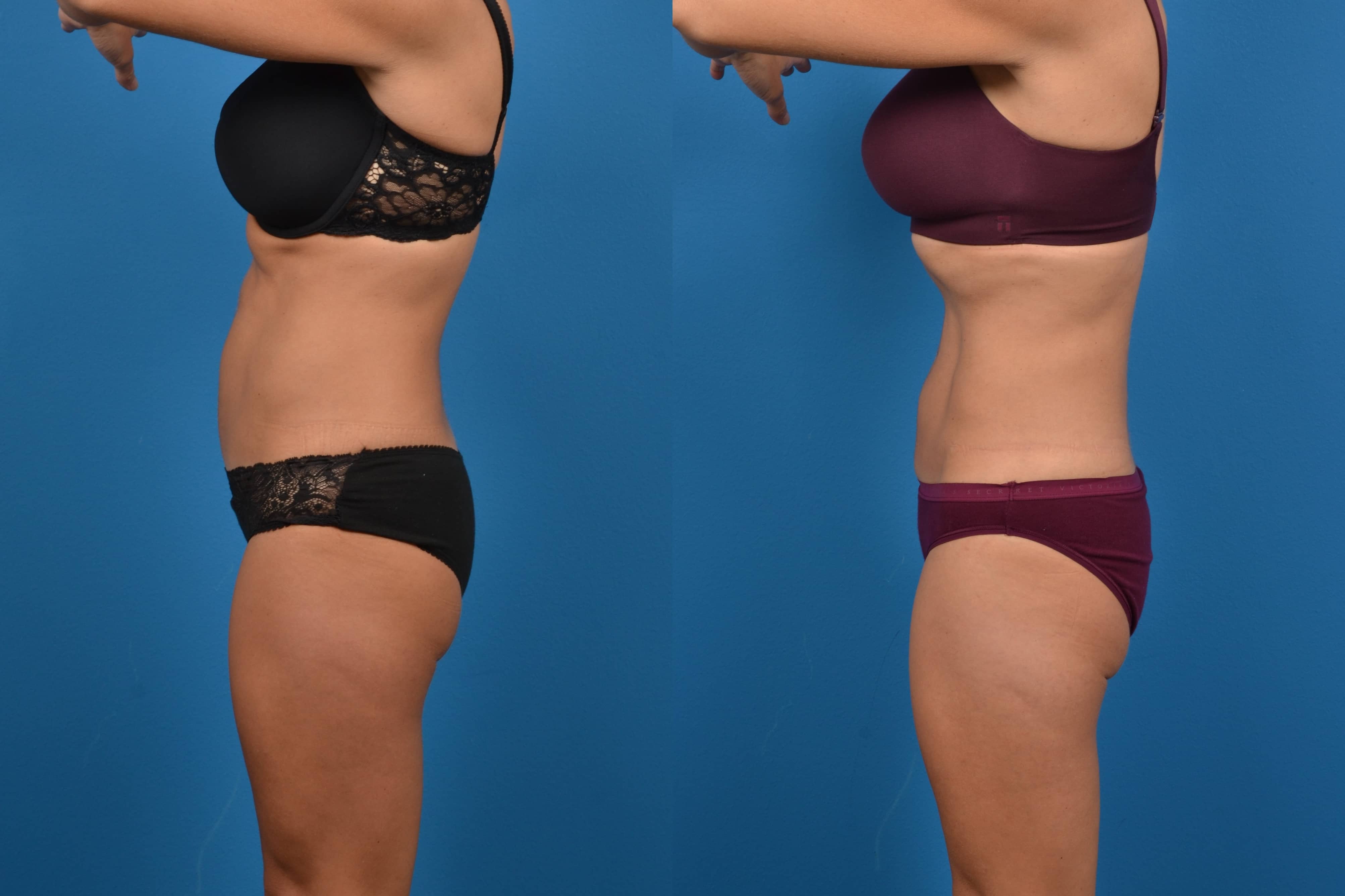 CoolSculpting Before & After Gallery - Patient 268673 - Image 2
