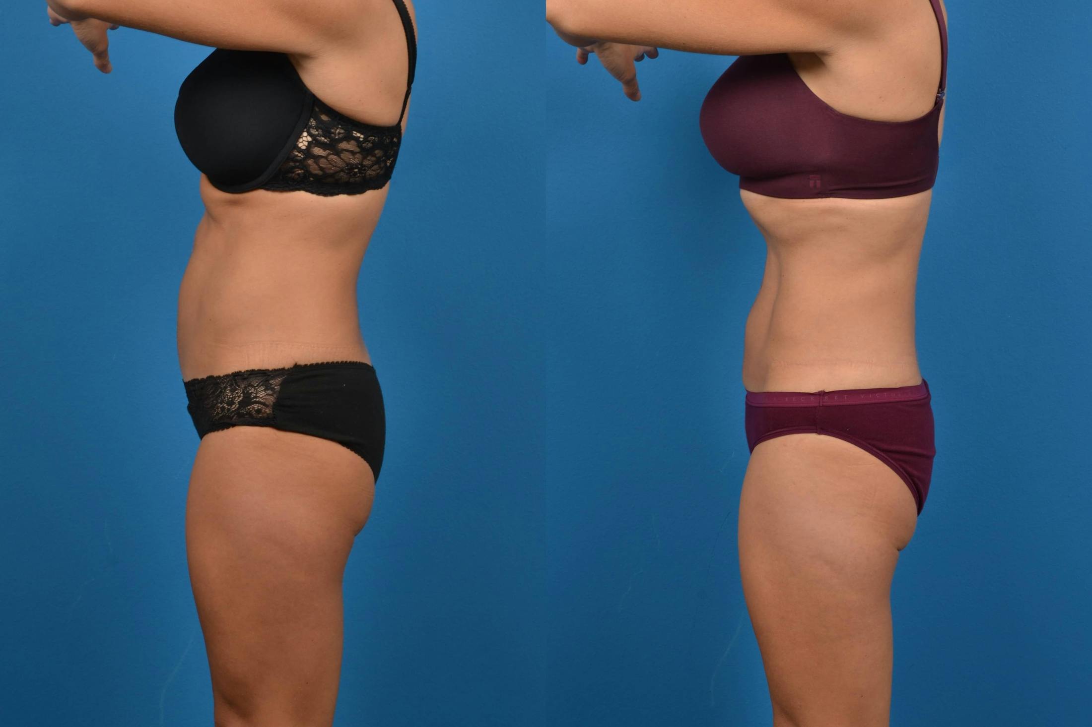 CoolSculpting Before & After Gallery - Patient 122405634 - Image 2