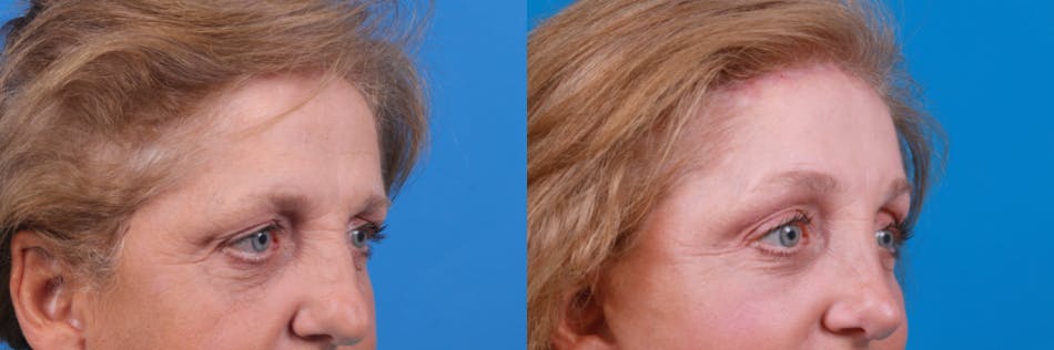 Brow Lift Before & After Gallery - Patient 122405633 - Image 3