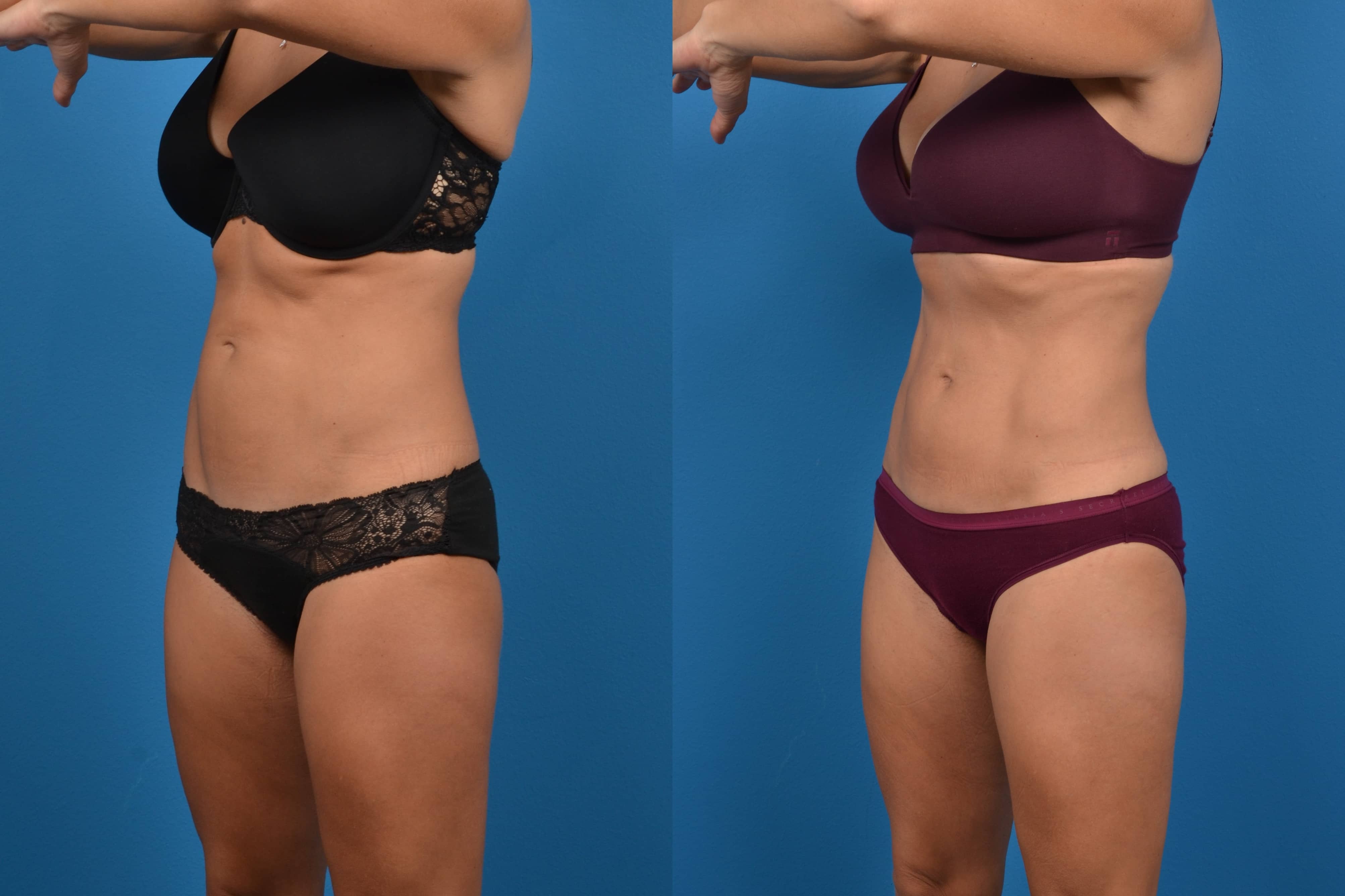 CoolSculpting Before & After Gallery - Patient 268673 - Image 3
