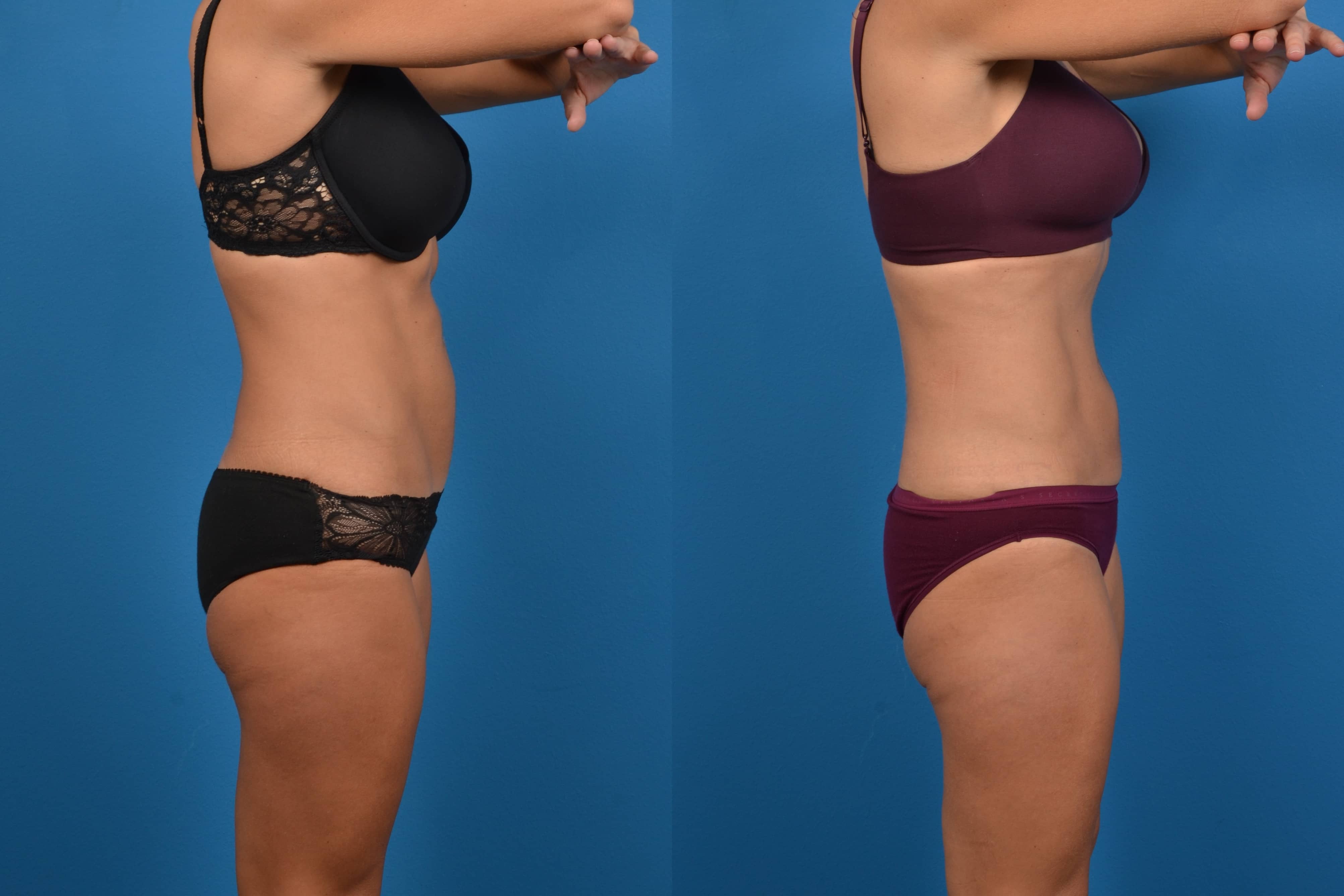 CoolSculpting Before & After Gallery - Patient 268673 - Image 4