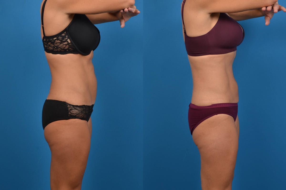 CoolSculpting Before & After Gallery - Patient 122405634 - Image 4