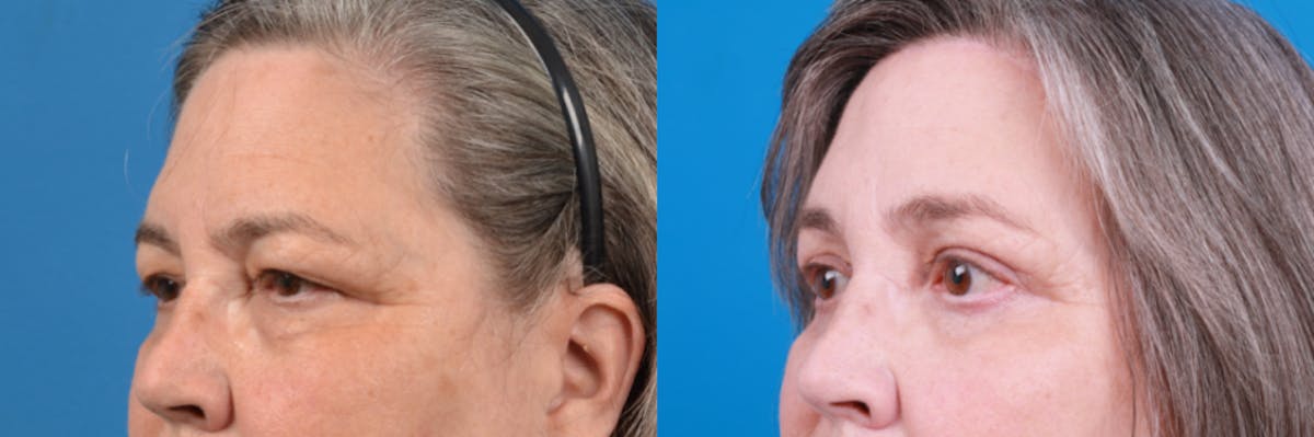 Brow Lift Before & After Gallery - Patient 122405635 - Image 1