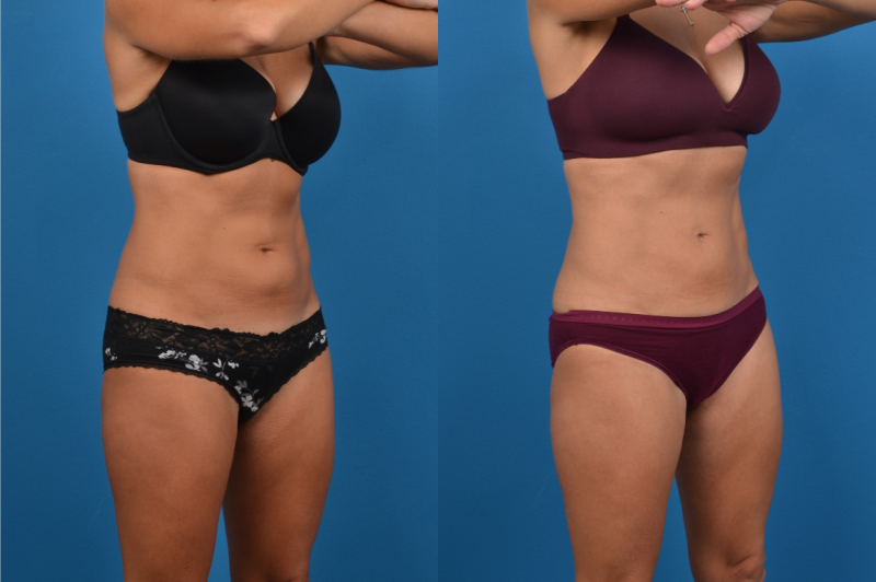 CoolSculpting Before & After Gallery - Patient 268673 - Image 5