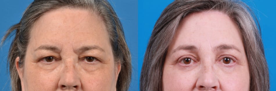 Brow Lift Before & After Gallery - Patient 122405635 - Image 2