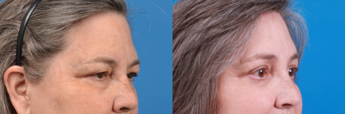 Brow Lift Before & After Gallery - Patient 122405635 - Image 3