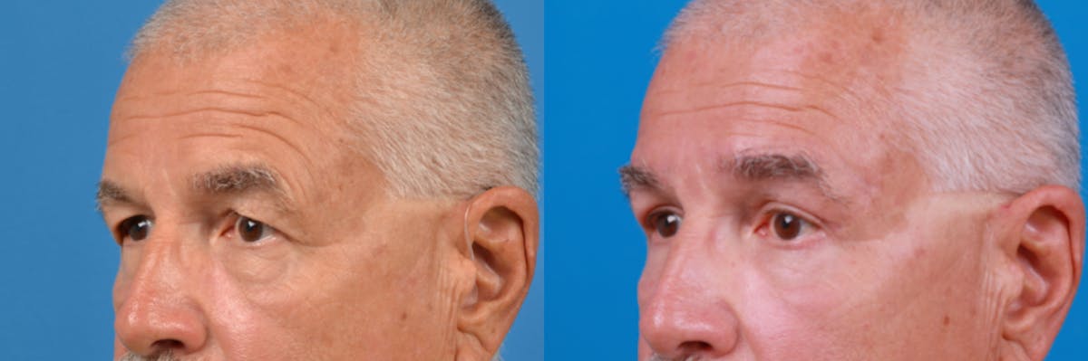 Brow Lift Before & After Gallery - Patient 122405636 - Image 1