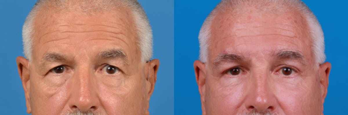 Brow Lift Before & After Gallery - Patient 122405636 - Image 2