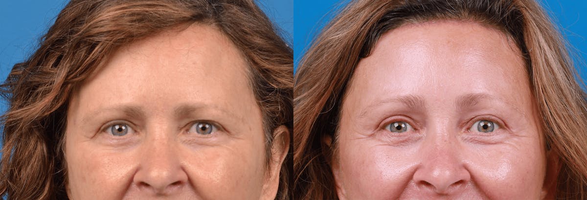 Brow Lift Before & After Gallery - Patient 122405637 - Image 1