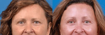 Brow Lift Before & After Gallery - Patient 122405637 - Image 1