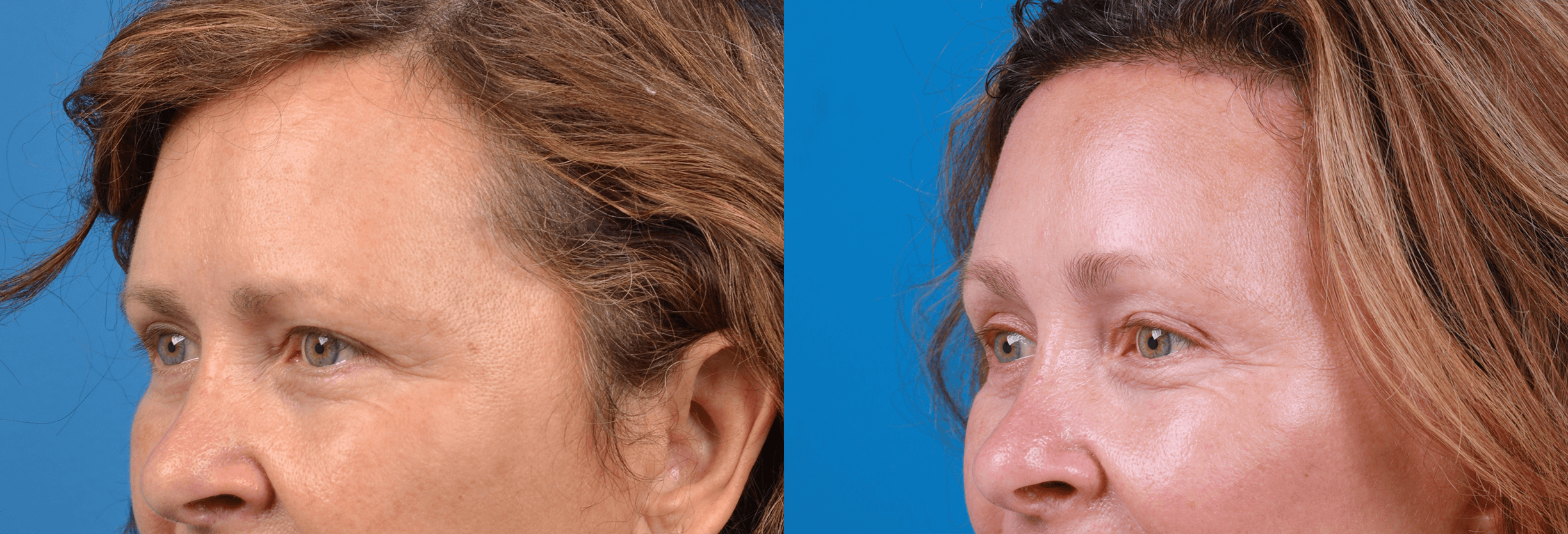 Brow Lift Before & After Gallery - Patient 122405637 - Image 2