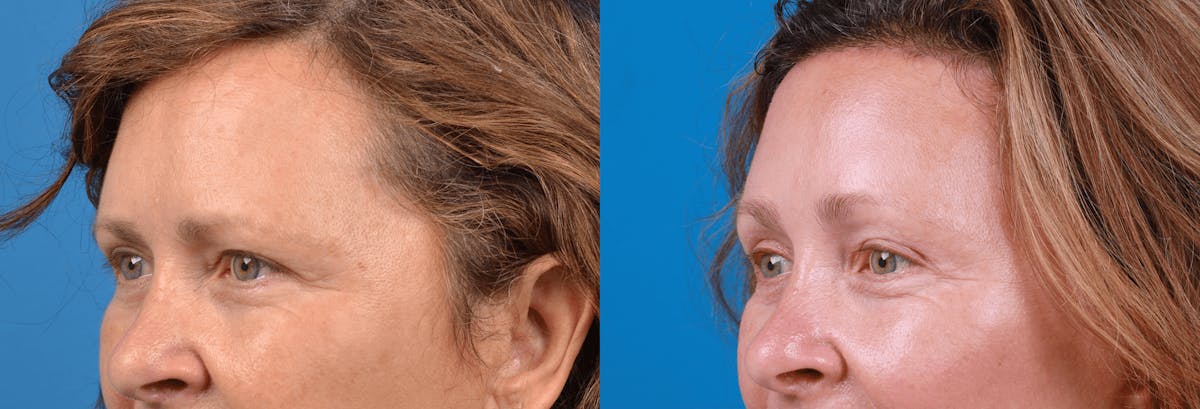 Brow Lift Before & After Gallery - Patient 122405637 - Image 2